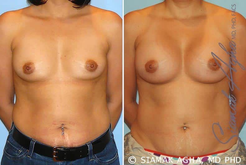 Breast Augmentation Before & After
