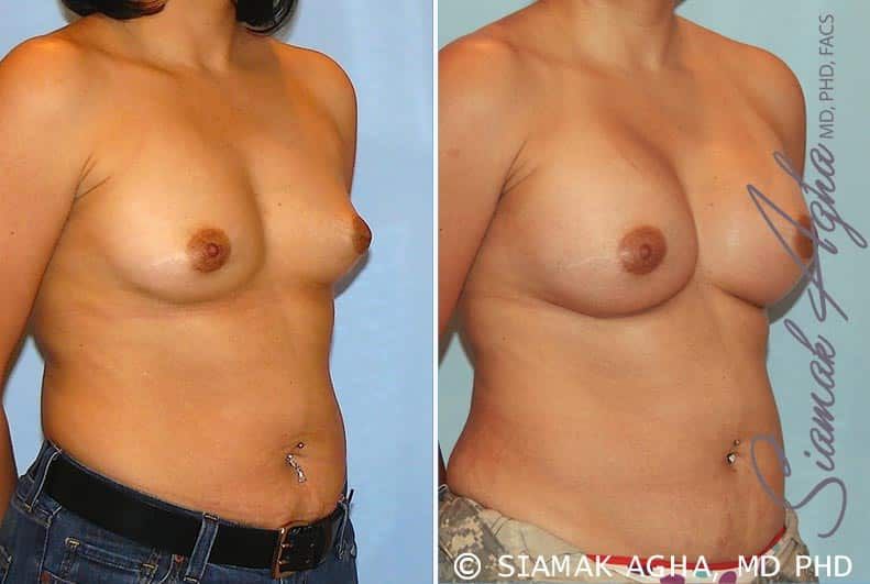 Breast Augmentation Before & After