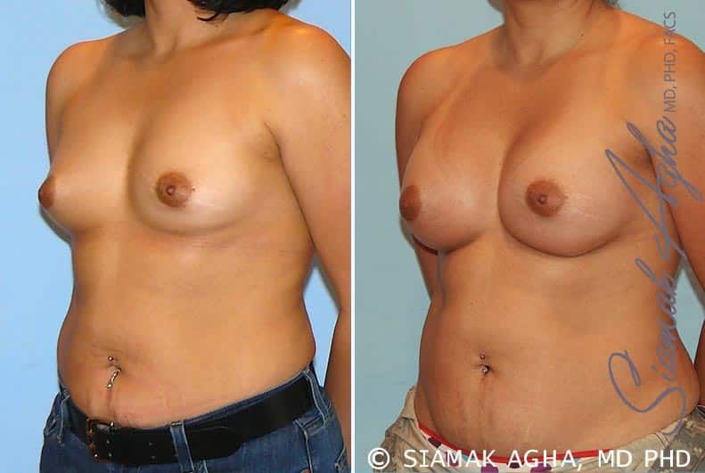 Breast Augmentation Before & After