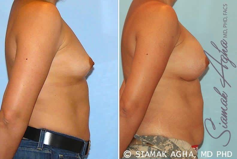 Breast Augmentation Before & After