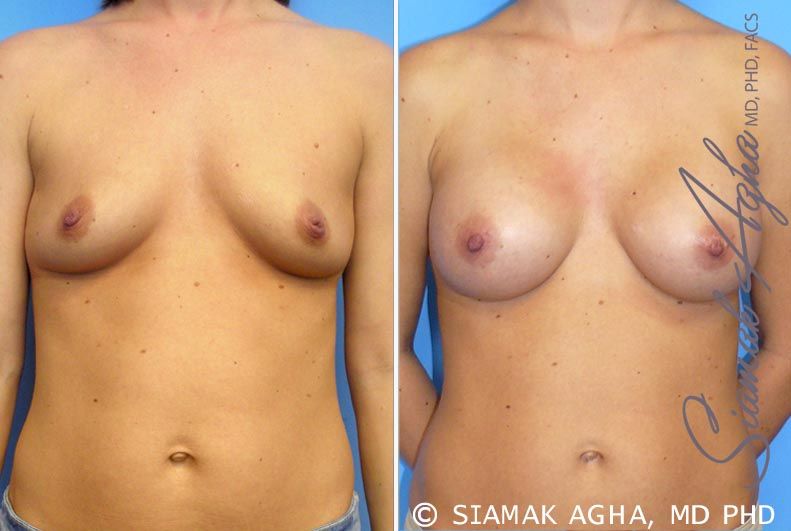Breast Augmentation Before & After
