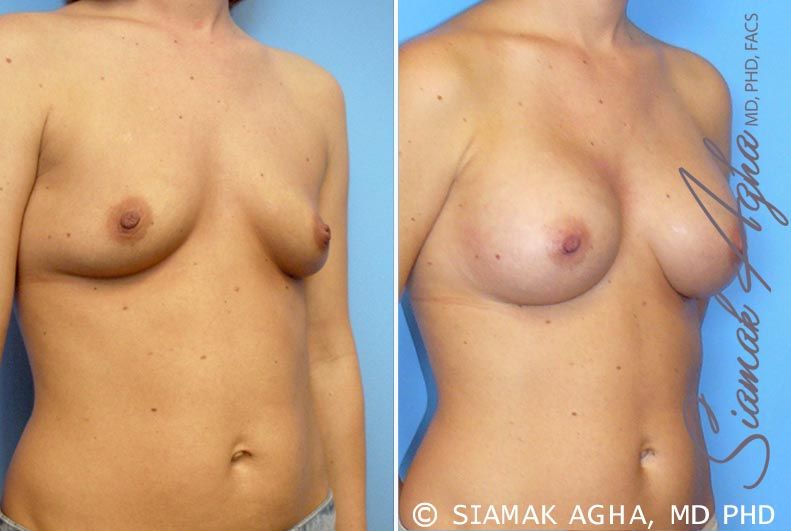 Breast Augmentation Before & After