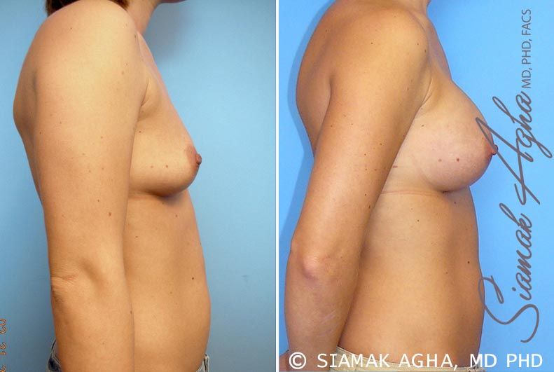 Breast Augmentation Before & After