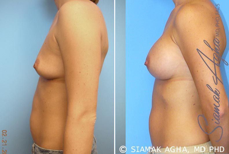Breast Augmentation Before & After