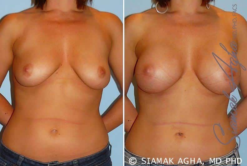 Breast Augmentation Before & After
