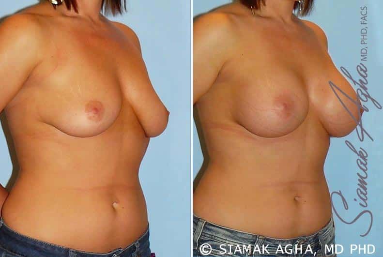 Breast Augmentation Before & After
