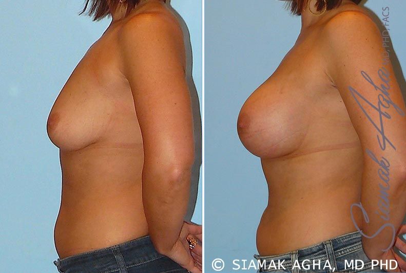 Breast Augmentation Before & After