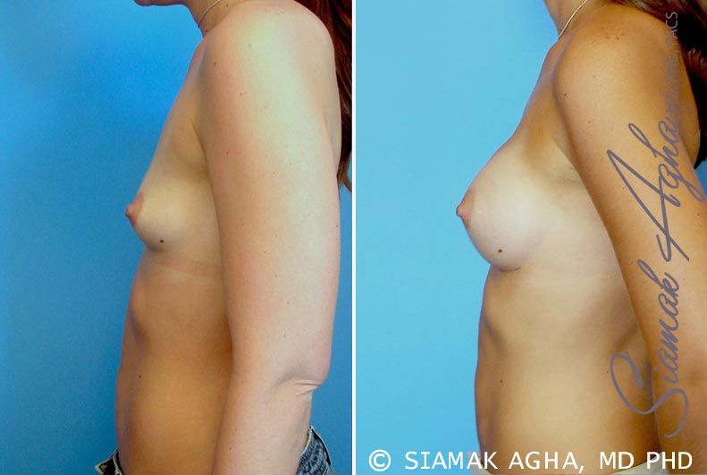 Breast Augmentation Before & After