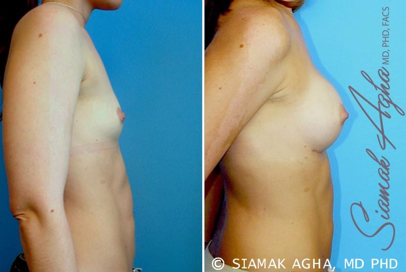 Breast Augmentation Before & After