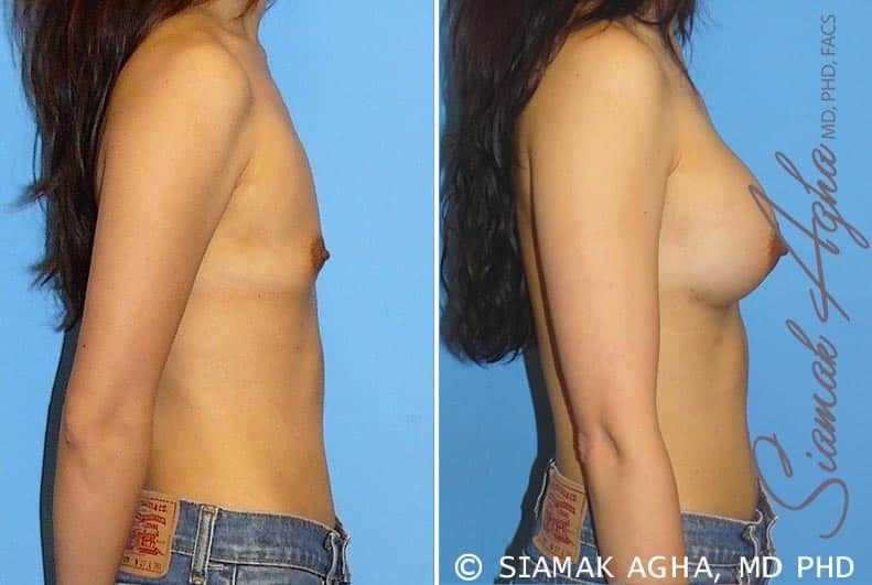Breast Augmentation Before & After