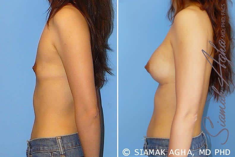 Breast Augmentation Before & After
