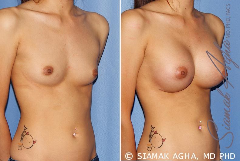 Breast Augmentation Before & After