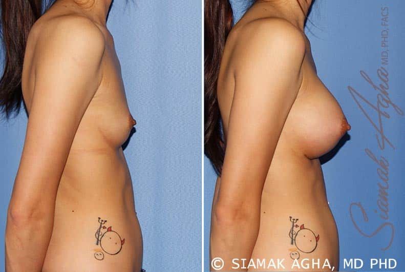 Breast Augmentation Before & After