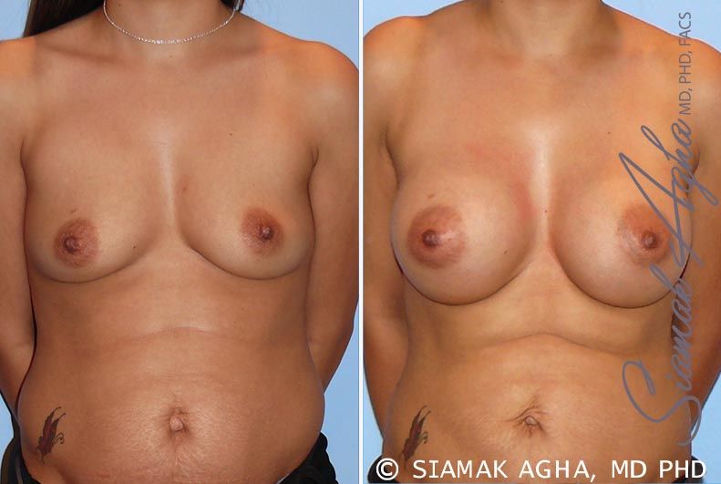 Breast Augmentation Before & After