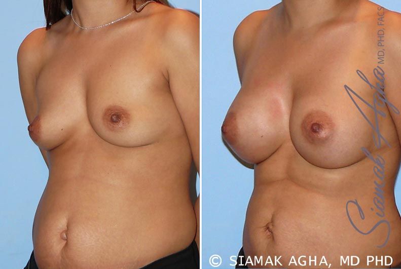 Breast Augmentation Before & After