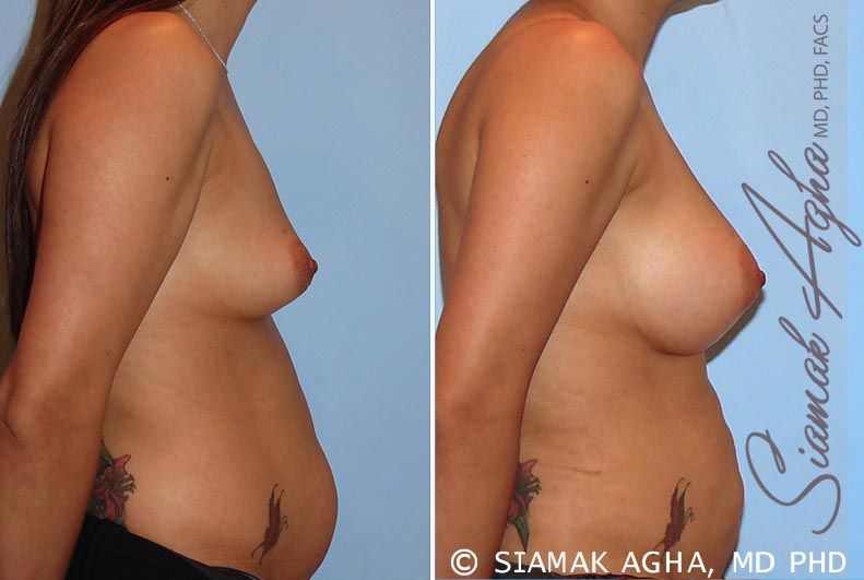 Breast Augmentation Before & After