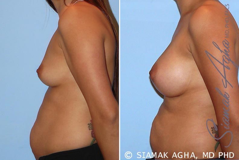 Breast Augmentation Before & After