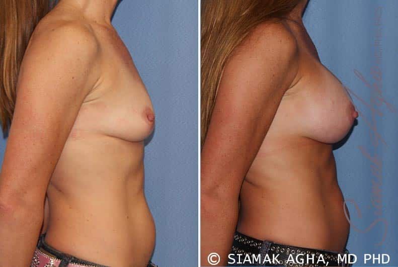 Breast Augmentation Before & After