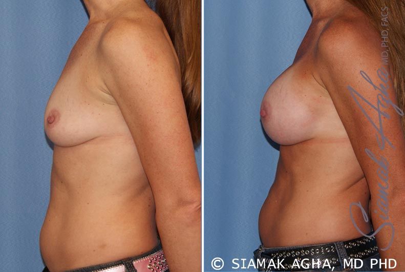 Breast Augmentation Before & After