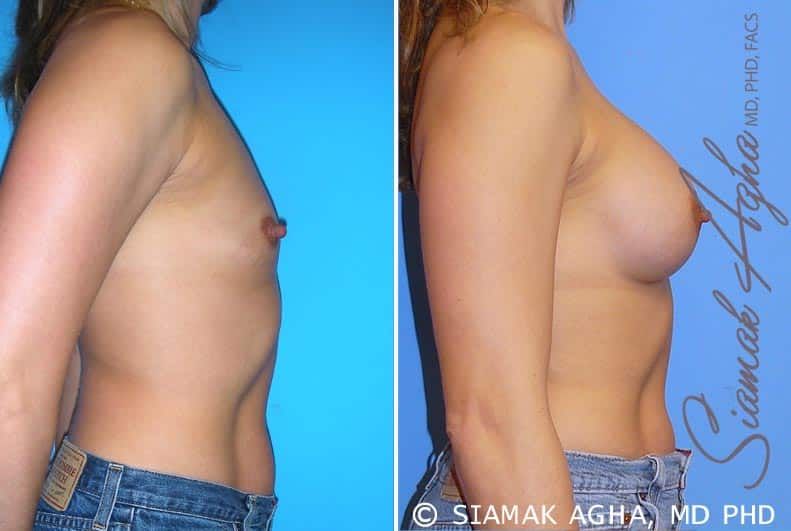 Breast Augmentation Before & After