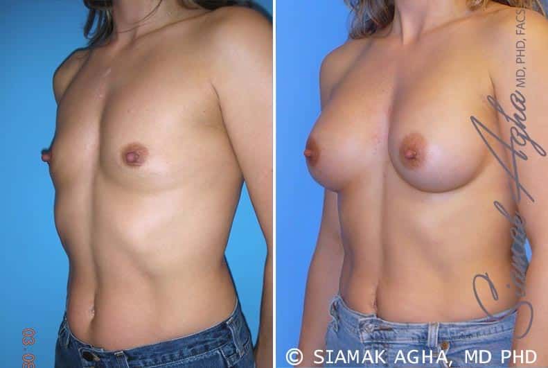 Breast Augmentation Before & After