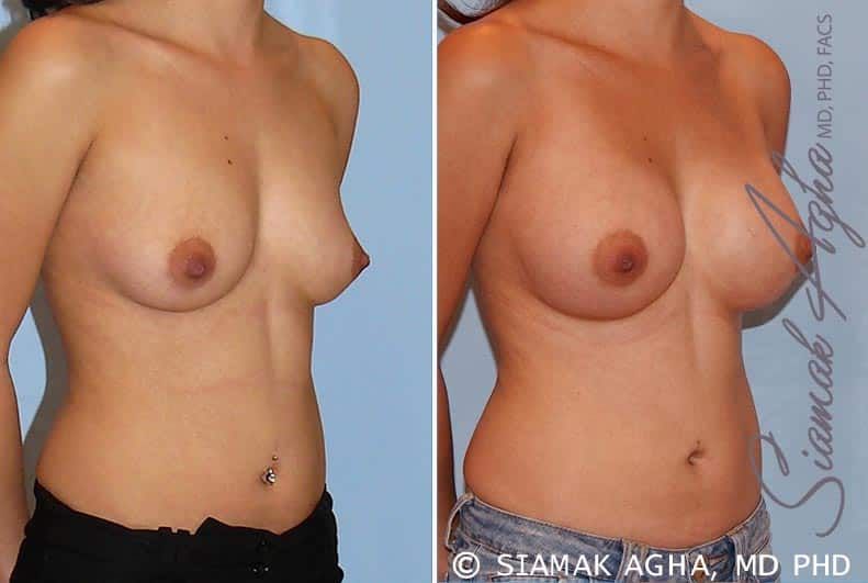 Breast Augmentation Before & After