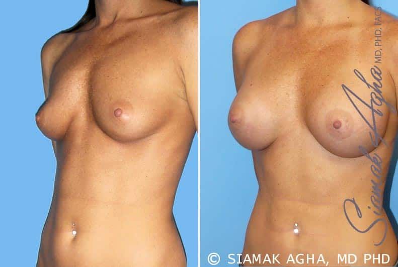 Breast Augmentation Before & After