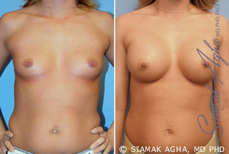 Breast Augmentation Before & After