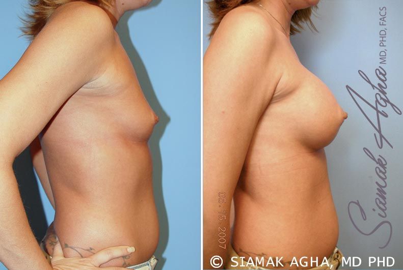 Breast Augmentation Before & After