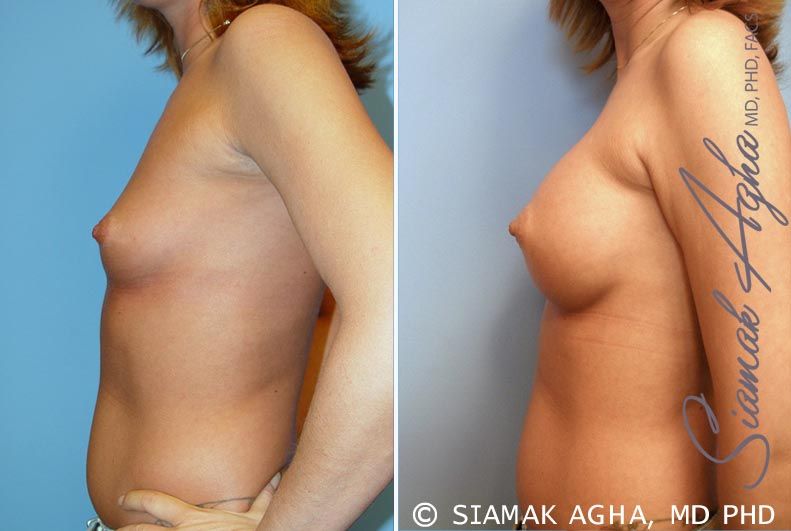 Breast Augmentation Before & After