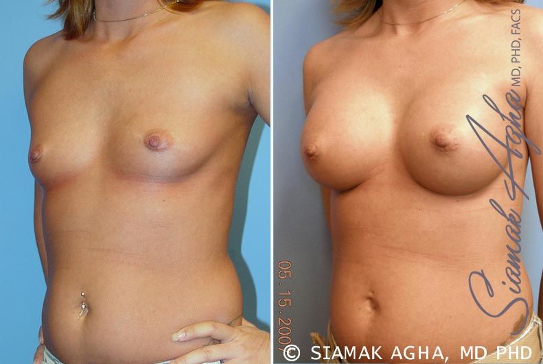 Breast Augmentation Before & After