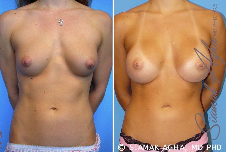Breast Augmentation Before & After