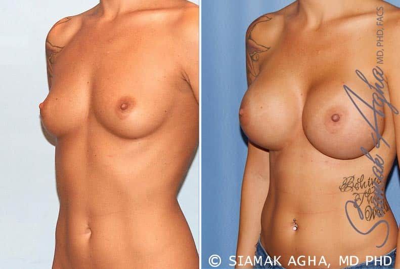 Breast Augmentation Before & After