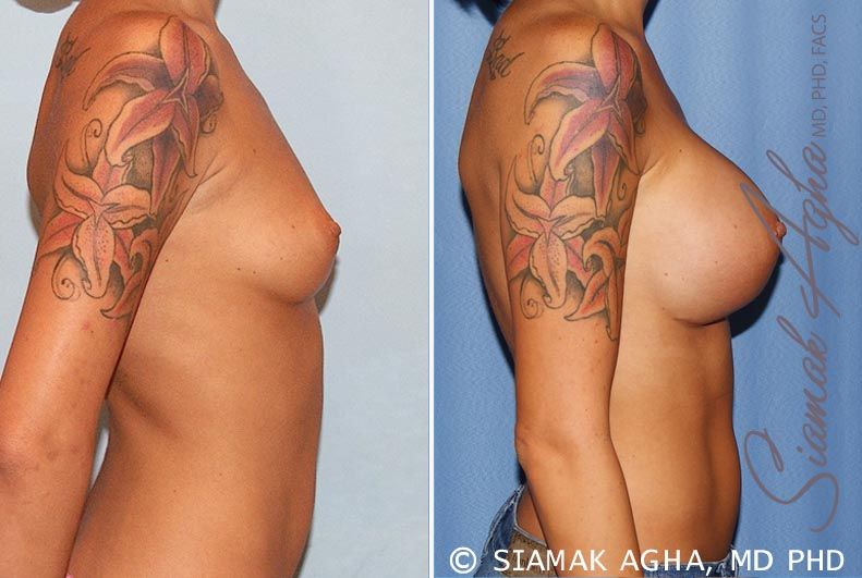 Breast Augmentation Before & After