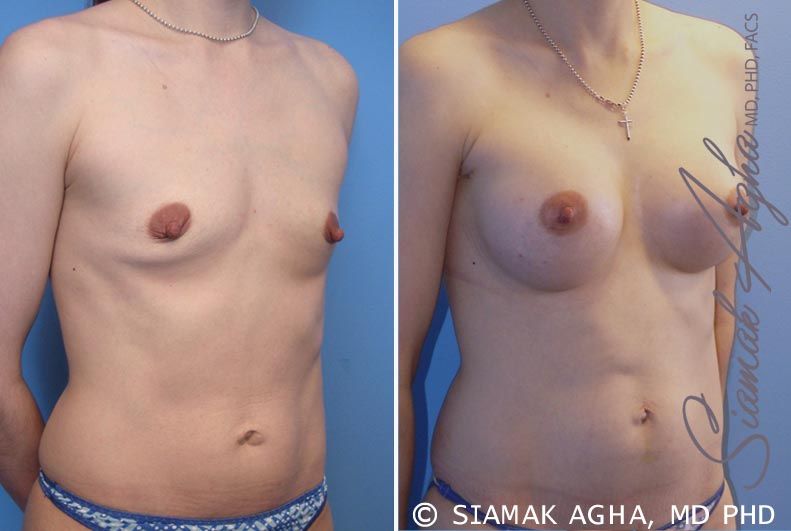 Breast Augmentation Before & After