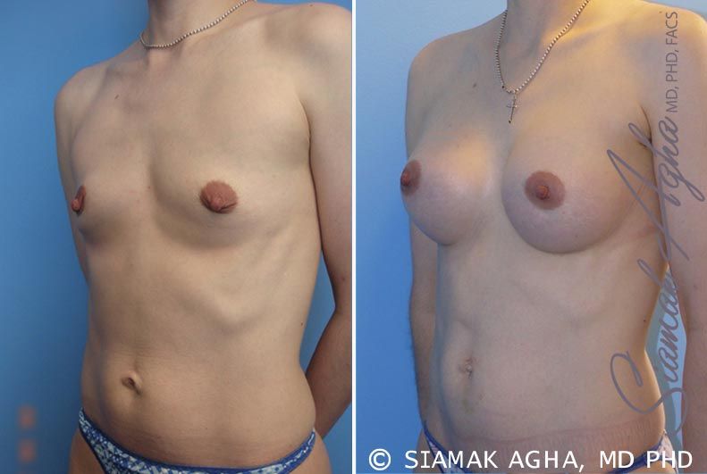 Breast Augmentation Before & After