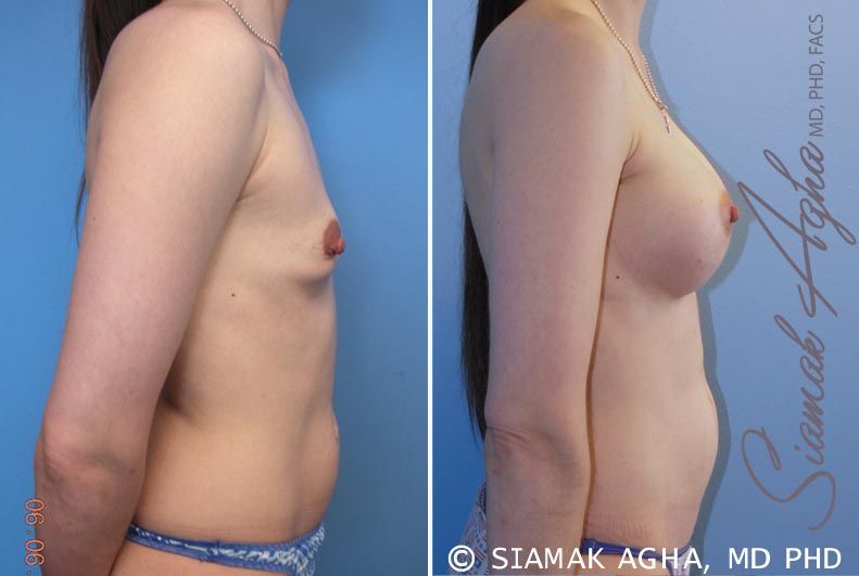 Breast Augmentation Before & After