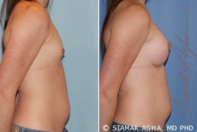 Breast Augmentation Before & After