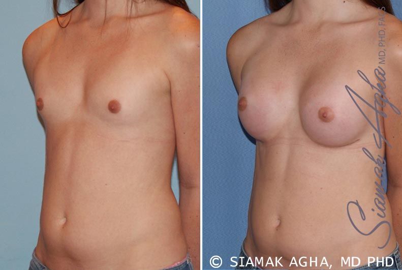Breast Augmentation Before & After