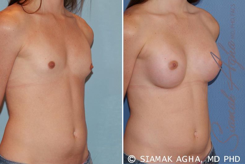 Breast Augmentation Before & After