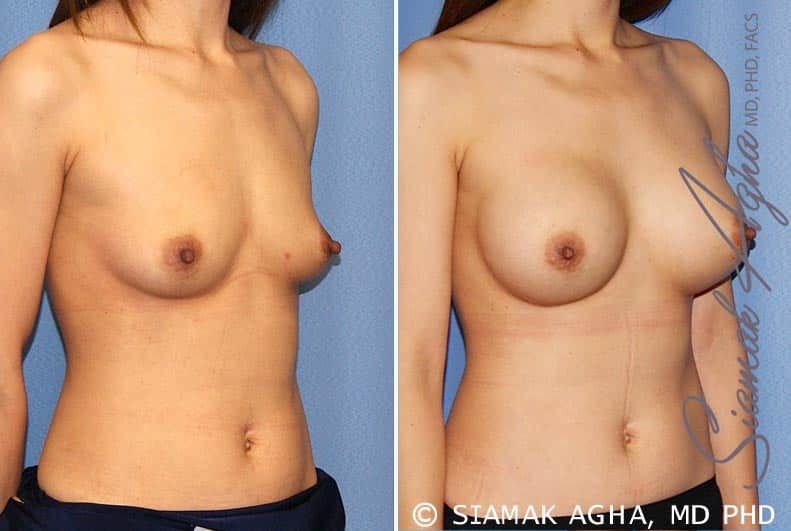 Breast Augmentation Before & After