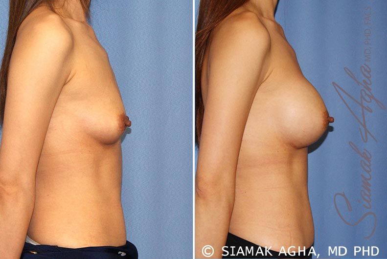 Breast Augmentation Before & After