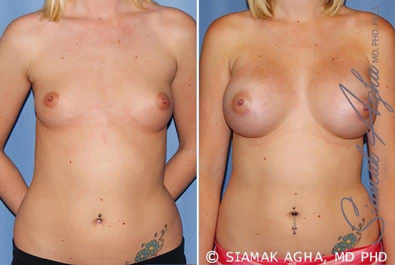 Breast Augmentation Before & After