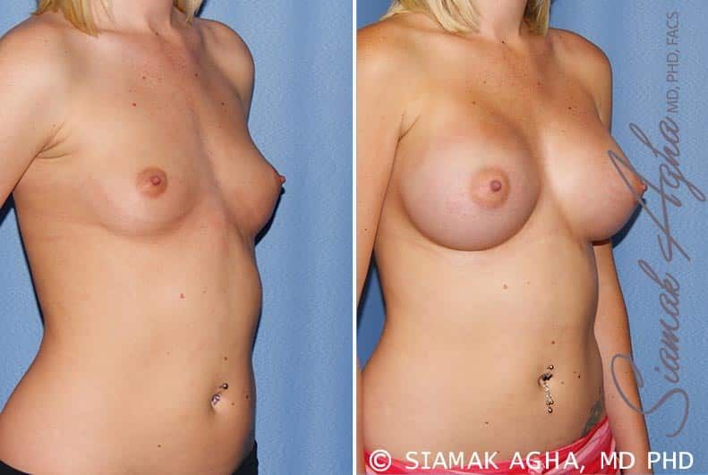 Breast Augmentation Before & After