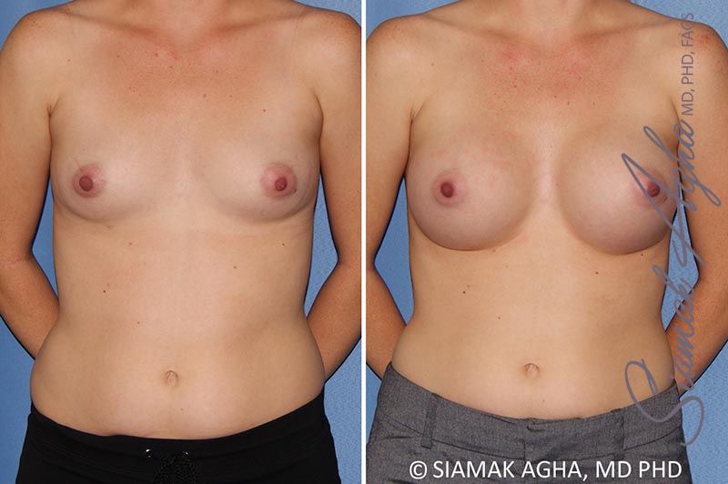 Breast Augmentation Before & After