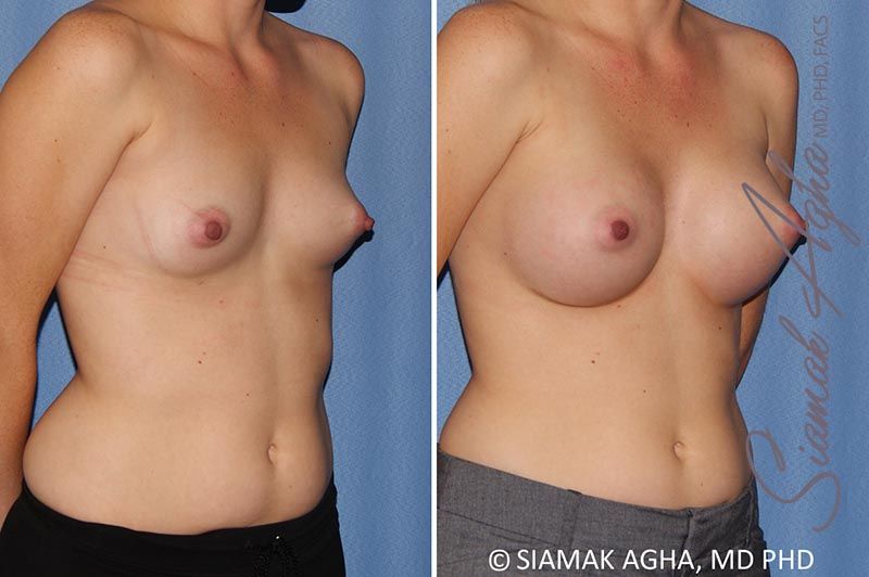 Breast Augmentation Before & After