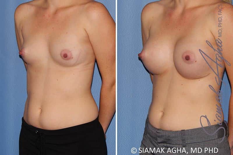 Breast Augmentation Before & After
