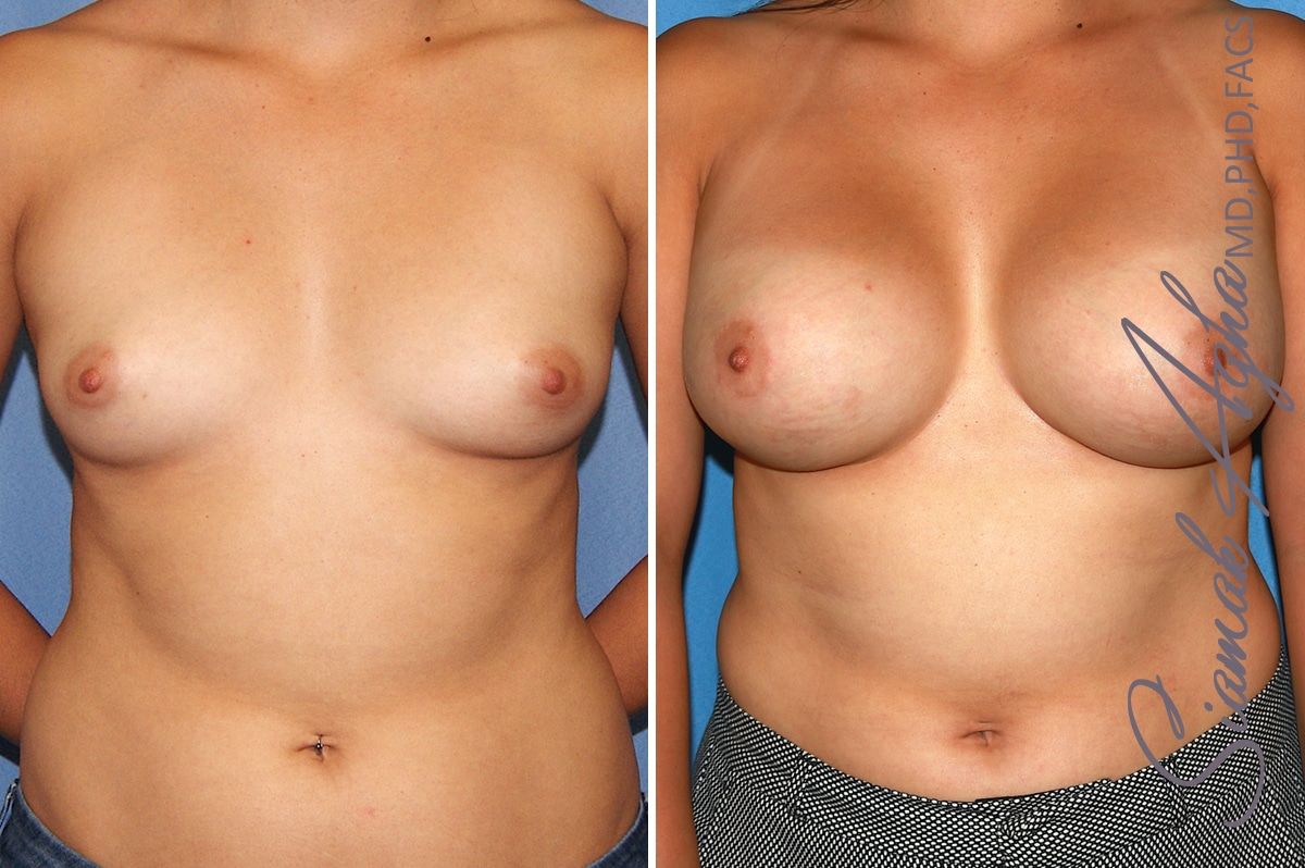 Breast Augmentation Before & After