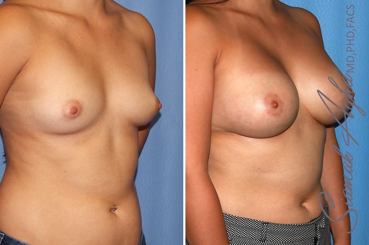 Breast Augmentation Before & After