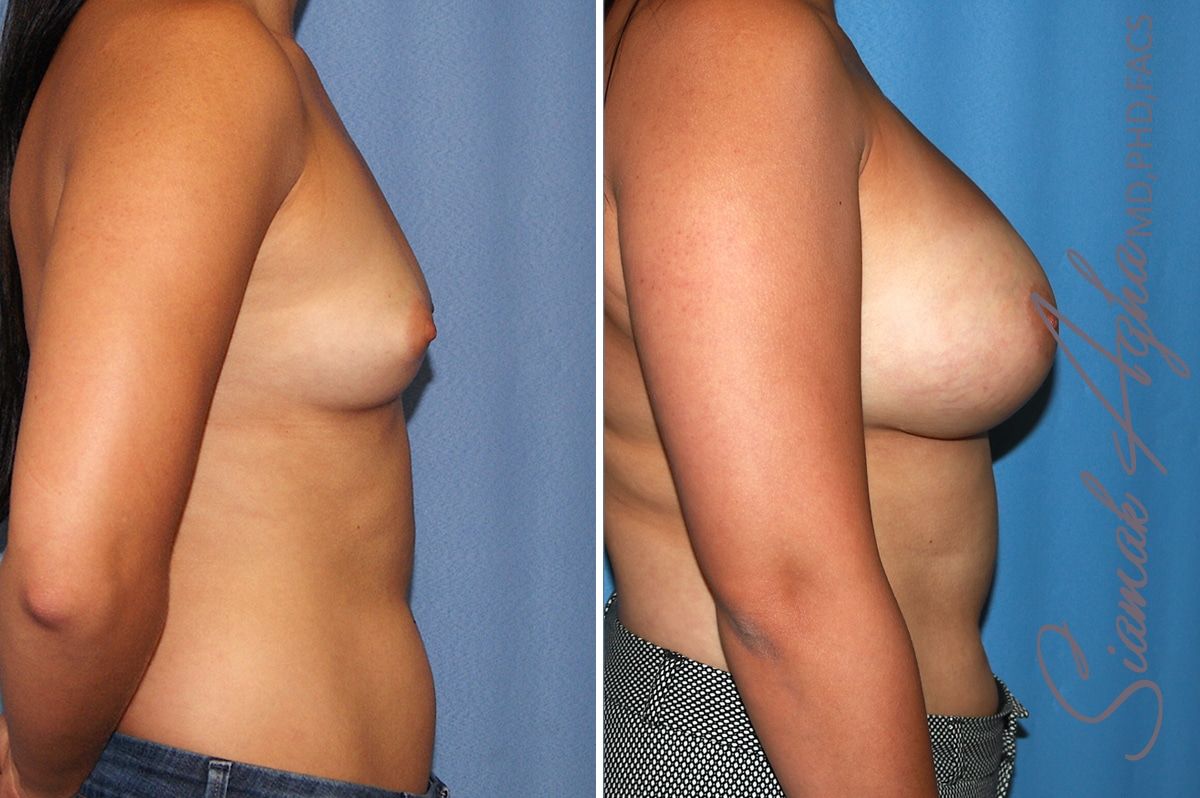 Breast Augmentation Before & After